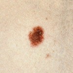 Skin cancer dysplastic nevus