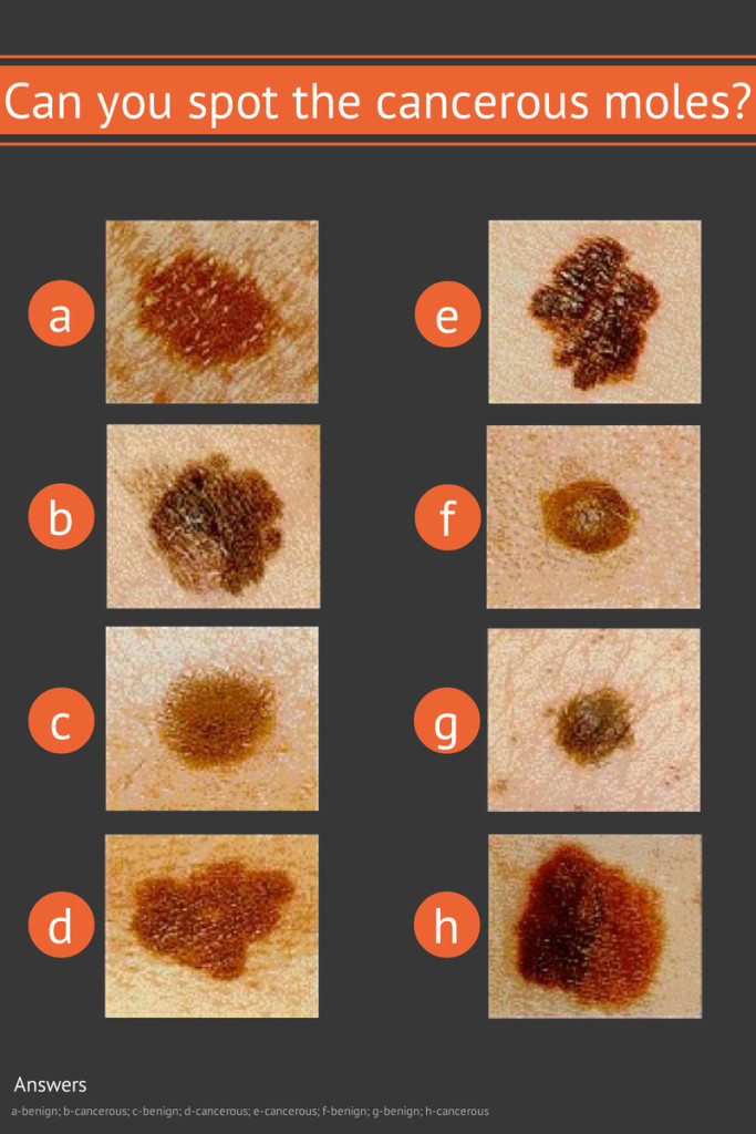 What Does Melanoma Look Like? - National Cancer Institute