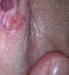Ulcere genitali